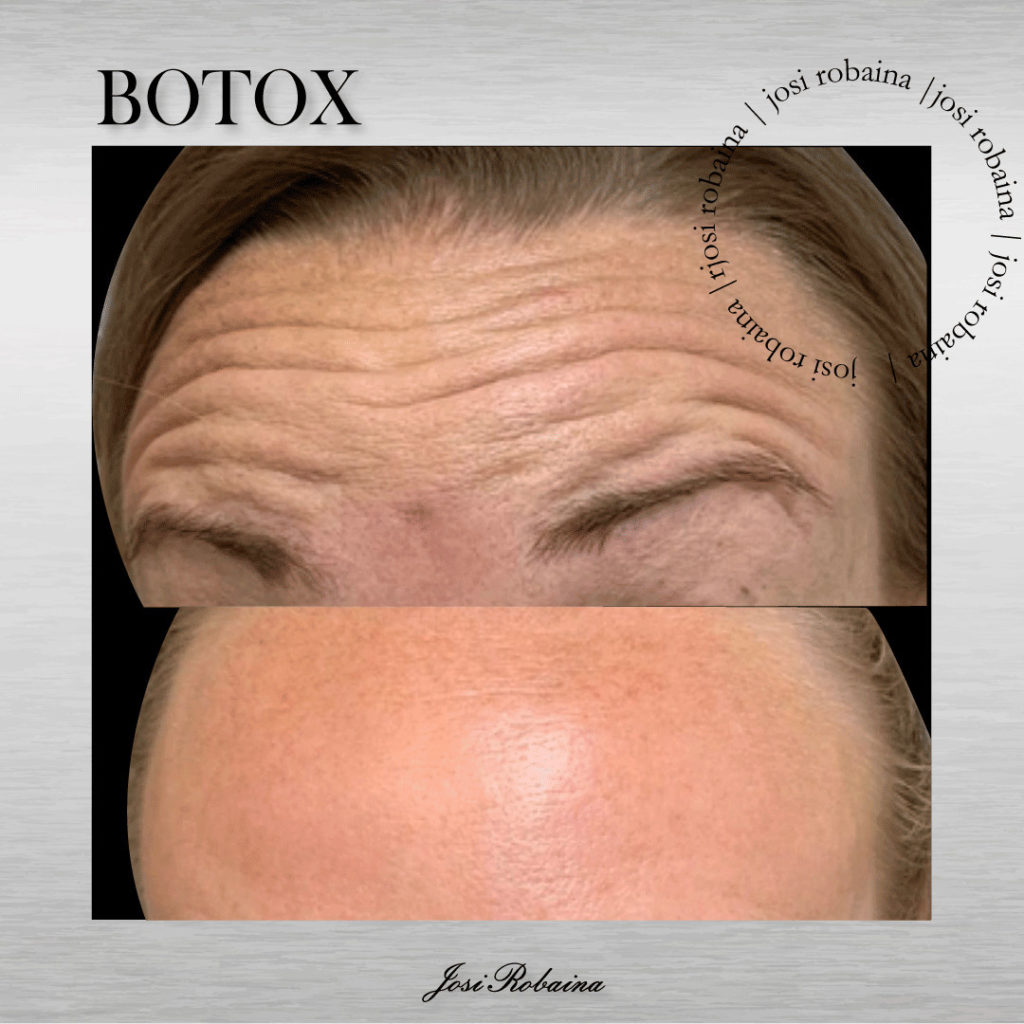 botox 1