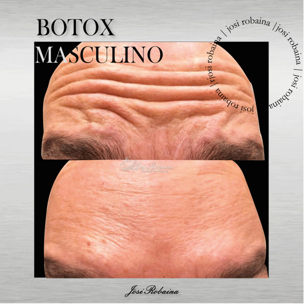 botox 2