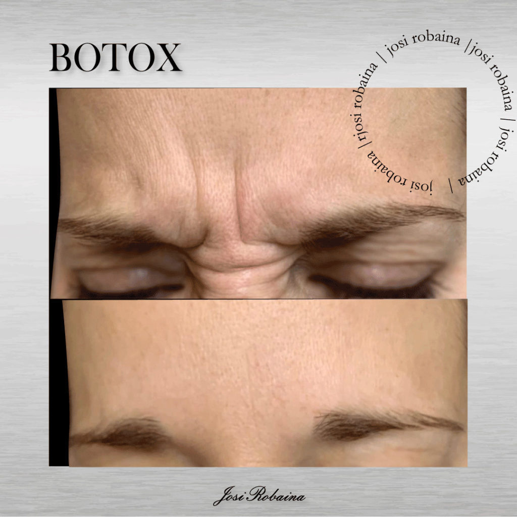 botox